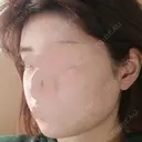 骨削り（頬） / 脂肪注入（肌） ボンディ美容整形外科（旧リオン整形外科） DAY 282 サムネイル用