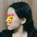 糸リフト / 脂肪吸引（顔） / その他（肌） ビューティーライン美容外科 DAY 41 サムネイル用