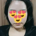 糸リフト / 脂肪吸引（顔） / その他（肌） ビューティーライン美容外科 DAY 41 サムネイル用