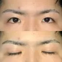 眼瞼下垂（切開） 札幌中央形成外科 AFTER サムネイル用