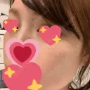 シミ取りレーザー / ルビーレーザー TOKUNAKAクリニック表参道本院 DAY 6 サムネイル用