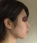脂肪溶解注射（顔） 赤坂プレミアクリニック DAY 1 サムネイル用