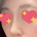 鼻修正 たにまちクリニック DAY 67 サムネイル用