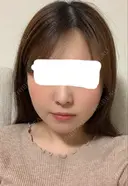 糸リフト / 骨切り（あご） / 骨削り（エラ） / 骨削り（頬） / 脂肪吸引（顔） RG整形外科（旧リオン整形外科） DAY 113 サムネイル用