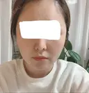 糸リフト / 骨切り（あご） / 骨削り（エラ） / 骨削り（頬） / 脂肪吸引（顔） RG整形外科（旧リオン整形外科） DAY 113 サムネイル用