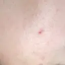 ほくろ・いぼ切除（肌） 赤坂メディカルMクリニック AFTER サムネイル用