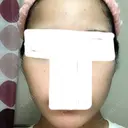 ボトックス（エラ・小顔） / 脂肪溶解注射（顔） / 脂肪溶解注射（二の腕） クリニックA.O. AFTER サムネイル用