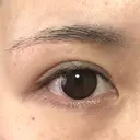 眉下切開 もとび美容外科クリニック 新宿院 DAY 185 サムネイル用
