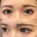 眉下切開 もとび美容外科クリニック 新宿院 DAY 209 サムネイル用