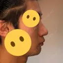 隆鼻術 / 鼻尖形成（切開） / 鼻中隔延長（切開） / 小鼻縮小（切開） / 軟骨移植 / 鼻孔縁挙上 / 鼻尖縮小 Zetith Beauty Clinic 銀座院 DAY 81 サムネイル用