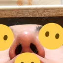 隆鼻術 / 鼻尖形成（切開） / 鼻中隔延長（切開） / 小鼻縮小（切開） / 軟骨移植 / 鼻孔縁挙上 / 鼻尖縮小 Zetith Beauty Clinic 銀座院 DAY 81 サムネイル用