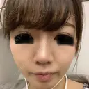 隆鼻術 / 鼻尖形成（切開） / 鼻中隔延長（切開） / 小鼻縮小（切開） / 鼻尖縮小 FROM B整形外科 (旧バウム整形外科) DAY 50 サムネイル用