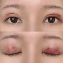 二重埋没 / 目元修正 BIANCA銀座 DAY 2 サムネイル用