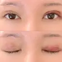 二重埋没 / 目元修正 BIANCA銀座 DAY 3 サムネイル用