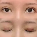 二重埋没 / 目元修正 BIANCA銀座 DAY 3 サムネイル用