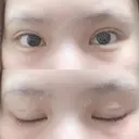 二重埋没 ビスポーククリニック 福岡院 DAY 37 サムネイル用