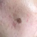 YAGレーザー 新宿美容外科クリニック 横浜院 DAY 1 サムネイル用