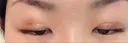 二重埋没 / 上まぶたの脂肪取り TCB東京中央美容外科 江坂院 DAY 4 サムネイル用