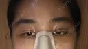 二重埋没 / 目頭切開 ラミチェ美容整形外科 DAY 3 サムネイル用