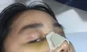 二重埋没 / 目頭切開 ラミチェ美容整形外科 DAY 7 サムネイル用