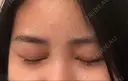 二重埋没 / 目頭切開 ラミチェ美容整形外科 DAY 162 サムネイル用