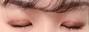 二重埋没 / 上まぶたの脂肪取り TCB東京中央美容外科 江坂院 DAY 5 サムネイル用