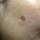 YAGレーザー 新宿美容外科クリニック 横浜院 DAY 1 サムネイル用