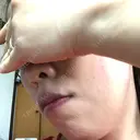 ピーリング（ニキビ・毛穴） 自由が丘クリニック DAY 22 サムネイル用