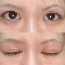 二重切開 / その他（目元） RG整形外科（旧リオン整形外科） AFTER サムネイル用