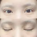 二重埋没 ビスポーククリニック 福岡院 DAY 40 サムネイル用