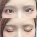 二重埋没 ビスポーククリニック 福岡院 DAY 40 サムネイル用