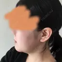 骨切り（あご） ボンディ美容整形外科（旧リオン整形外科） DAY 91 サムネイル用