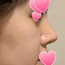 隆鼻術 / 鼻尖形成（切開） / 鼻中隔延長（切開） / 小鼻縮小（切開） / 眉間プロテーゼ ラミチェ美容整形外科 DAY 153 サムネイル用