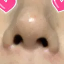 隆鼻術 / 鼻尖形成（切開） / 鼻中隔延長（切開） / 小鼻縮小（切開） / 眉間プロテーゼ ラミチェ美容整形外科 DAY 153 サムネイル用