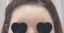 額を丸く / 脂肪注入（額） / ヒアルロン酸注入（額） / その他（輪郭） エートップ美容整形外科 AFTER サムネイル用