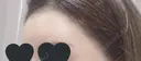 額を丸く / 脂肪注入（額） / ヒアルロン酸注入（額） / その他（輪郭） エートップ美容整形外科 DAY 11 サムネイル用