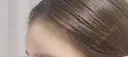 額を丸く / 脂肪注入（額） / ヒアルロン酸注入（額） / その他（輪郭） エートップ美容整形外科 DAY 9 サムネイル用