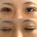 二重埋没 湘南美容クリニック 松山院 DAY 0 サムネイル用