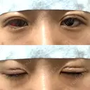二重埋没 湘南美容クリニック 松山院 DAY 0 サムネイル用