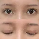 二重埋没 / 目元修正 BIANCA銀座 DAY 7 サムネイル用