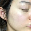ピコレーザートーニング（美白・肝斑） UB CLINIC 銀座 AFTER サムネイル用