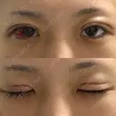二重埋没 湘南美容クリニック 松山院 DAY 0 サムネイル用
