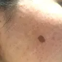 YAGレーザー 新宿美容外科クリニック 横浜院 DAY 4 サムネイル用