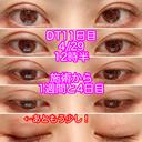 二重埋没 ビスポーククリニック 福岡院 DAY 11 サムネイル用