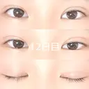 二重埋没 / 上まぶたの脂肪取り 品川スキンクリニック沖縄院 DAY 12 サムネイル用