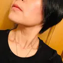 バッカルファット除去 TCB東京中央美容外科 堺院 DAY 6 サムネイル用