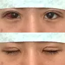 二重埋没 湘南美容クリニック 松山院 DAY 1 サムネイル用