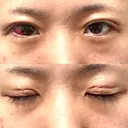 二重埋没 湘南美容クリニック 松山院 DAY 1 サムネイル用