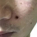 ほくろ・いぼ切除（肌） 大山皮膚科 DAY 9 サムネイル用