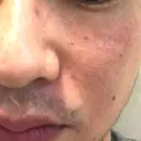 ほくろ・いぼ切除（肌） 大山皮膚科 AFTER サムネイル用